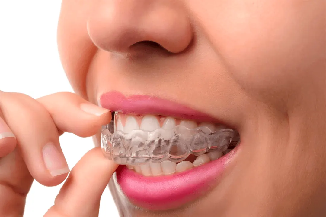 Clear Invisalign aligner